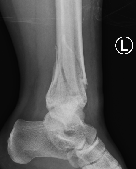 Distal tibia plate 2